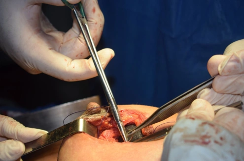 Understanding the Benefits of Breast Reduction Surgery